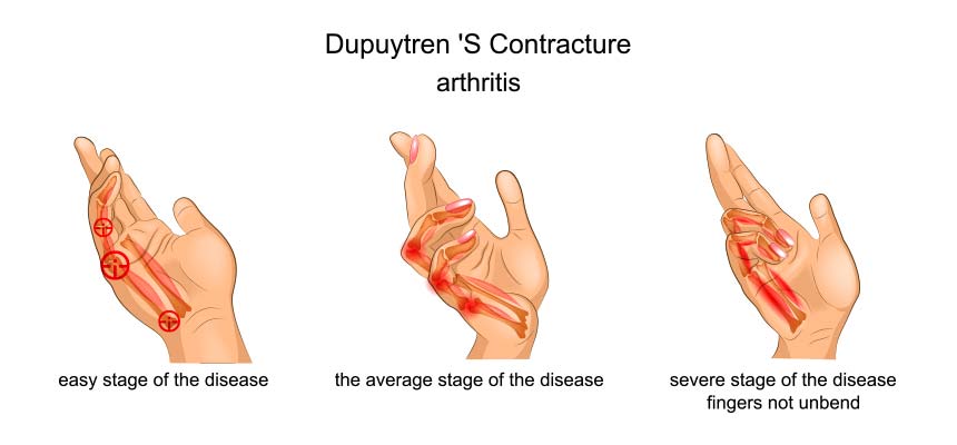 Patologia Dupuytren