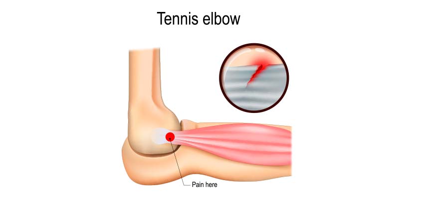 Patologia Epicondilitis o codo de tenista