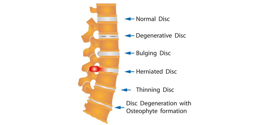 Patologia Hernias discales