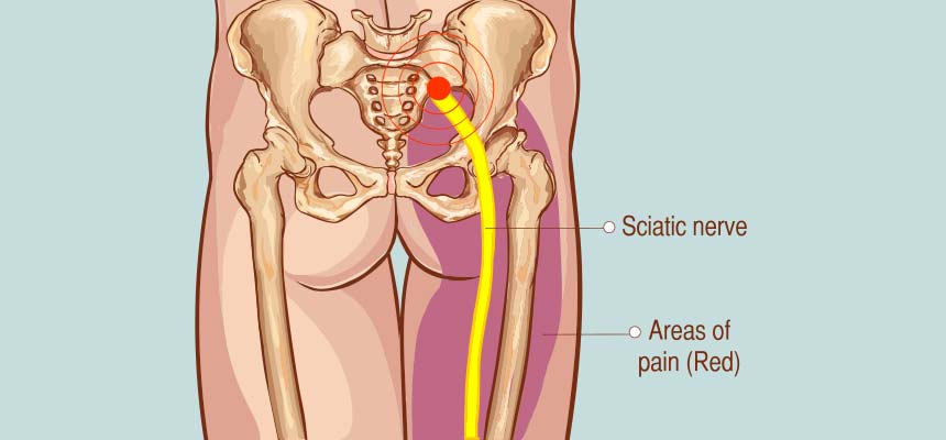 Patologia Hernias discales y Ciática