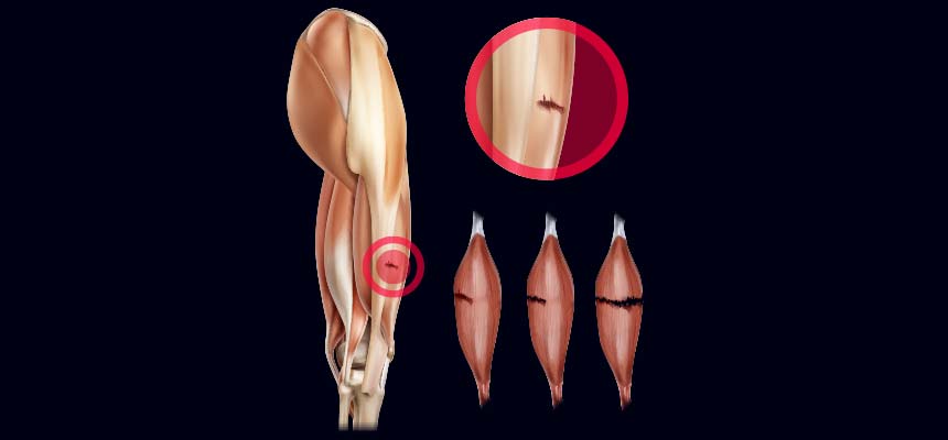 Patologia Roturas de Fibras en el muslo