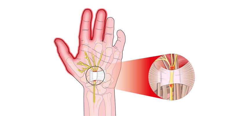 SÍNDROME DEL TÚNEL CARPIANO: ¿Qué es?, anatomía, causas y más