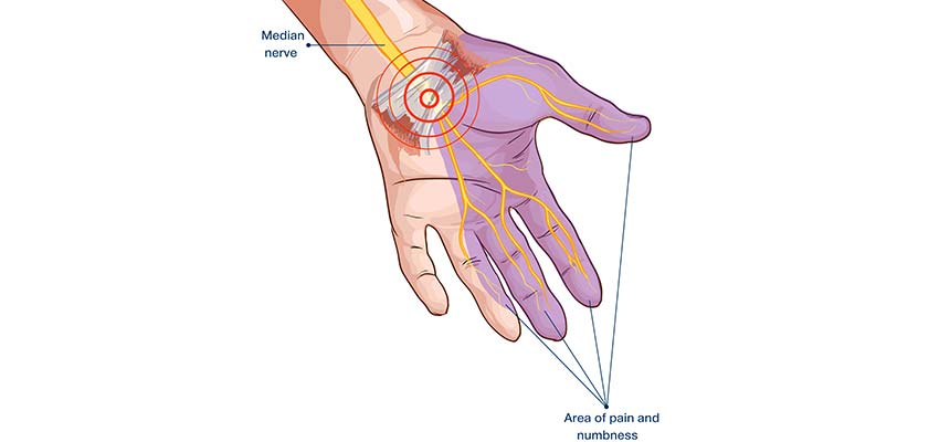 Qué es el síndrome del túnerl carpiano? - RP Clinic Fisioterapia Móstoles