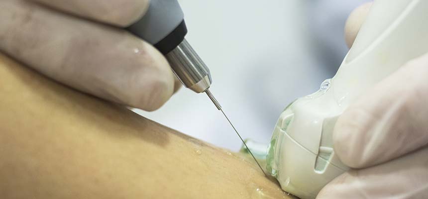 Tratamiento de Roturas fibrilares, en Fisioterapia Martín Vasco, Talavera de la Reina