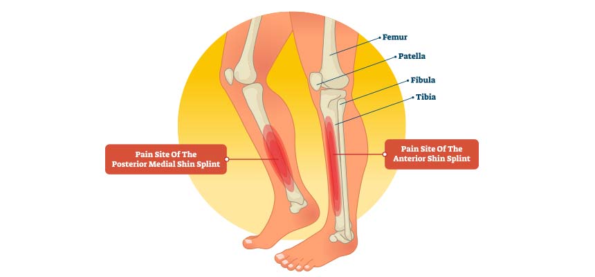 Patología periostitis tibial