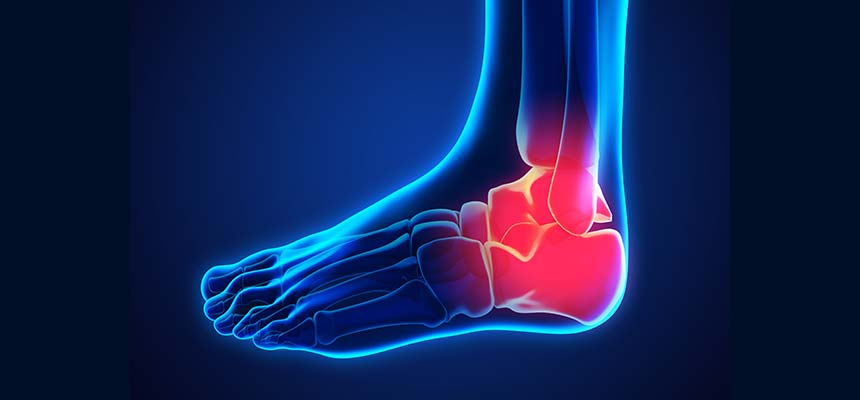 Patología pinzamiento de tobillo o impigement