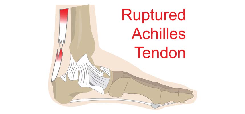 Patología tendinitis de Aquiles