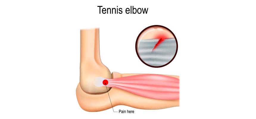 Tratamiento de Tendinitis (codo de tenista, tendón de Aquiles
