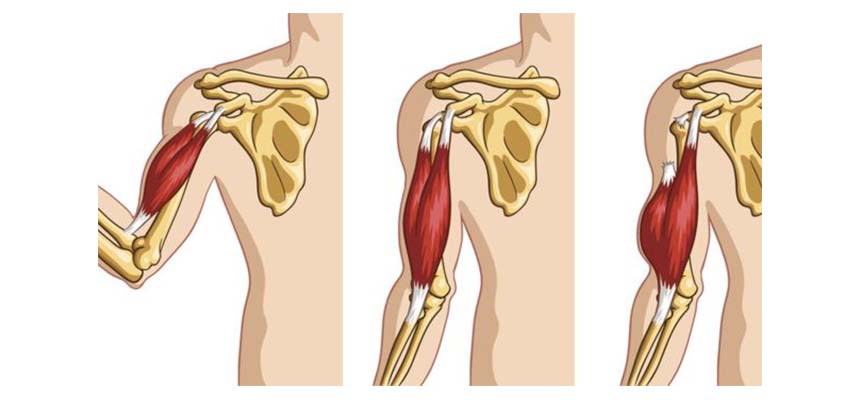 Biceps. Roturas de fibras y tendinosas (signo de Popeye) - Clínica de Fisioterapia Avanzada Martín Vasco, Talavera