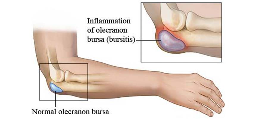 Bursitis olecraniana o bursitis del estudiante - Clínica de Fisioterapia Avanzada Martín Vasco, Talavera