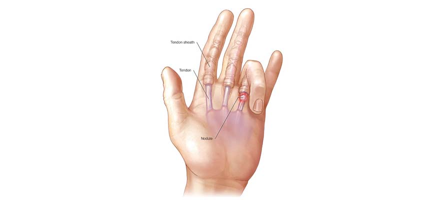 Dedo en resorte - Clínica de Fisioterapia Avanzada Martín Vasco, Talavera