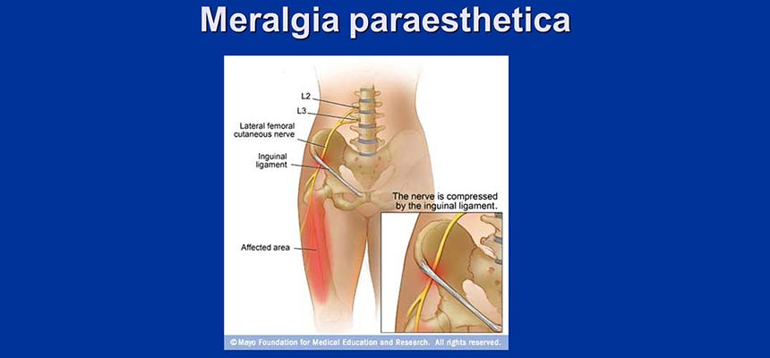 Meralgia Parestésica - Clínica de Fisioterapia Avanzada Martín Vasco, Talavera