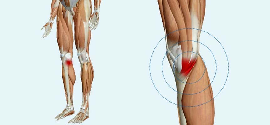 Tendinitis pata de ganso - Clínica de Fisioterapia Avanzada Martín Vasco, Talavera