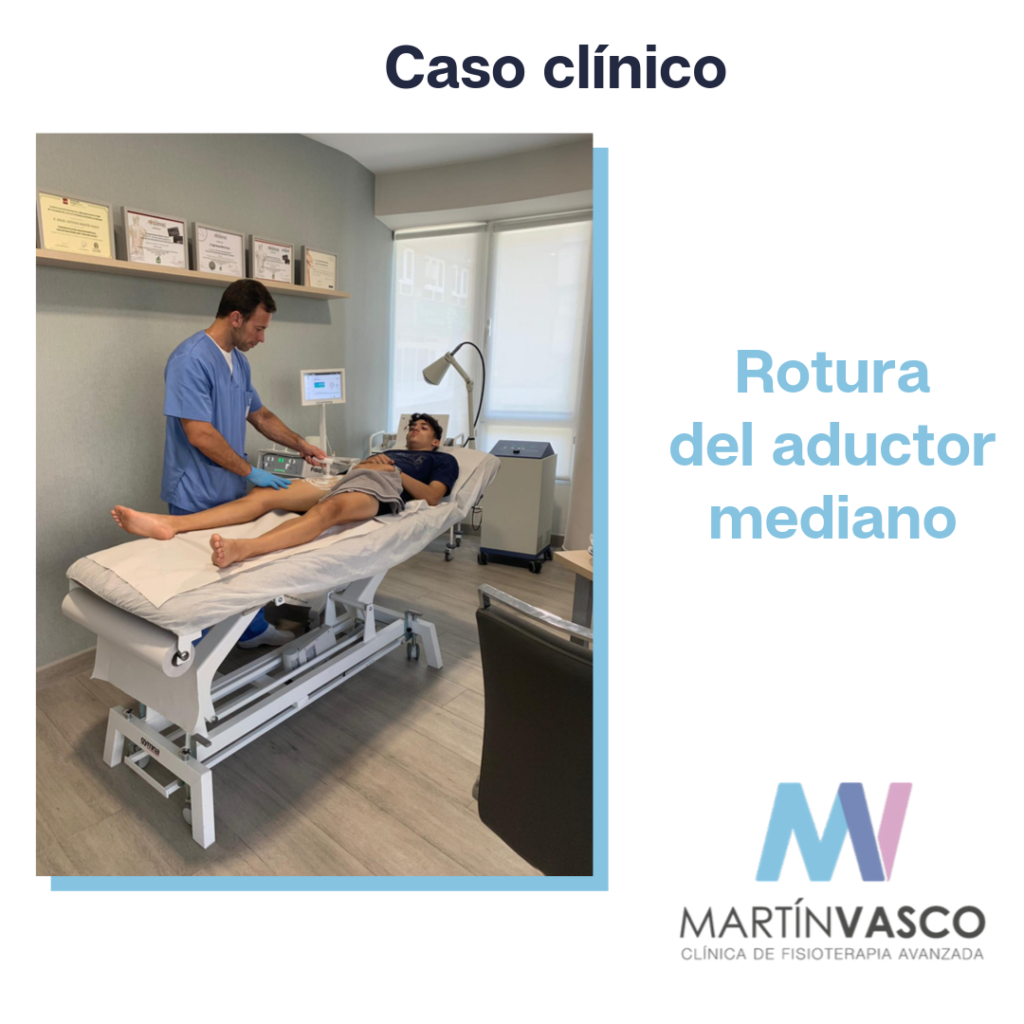 Rotura del Aductor Mediano - Fisioterapia Talavera