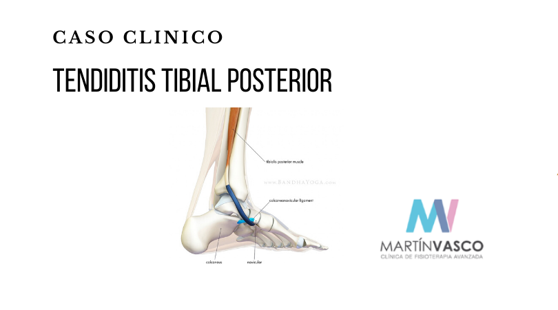 Tendiditis tibial posterior - Fisioterapia Talavera