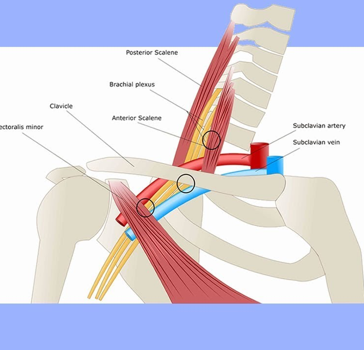 S ndrome Del Desfiladero Tor cico Fisioterapia Talavera Mart n Vasco s-ndrome-del-desfiladero-tor-cico-fisioterapia-talavera-mart-n-vasco