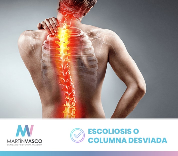 Escoliosis o desviación lateral de columna - Qué es, causas, tipos