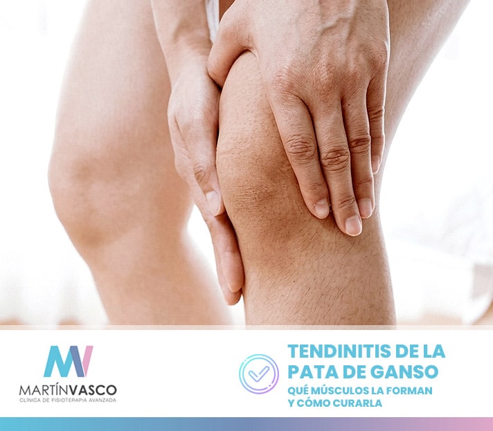 Esquema anatómico de los músculos sartorio, grácil y semitendinoso formando el tendón de la pata de ganso en la cara interna de la tibia